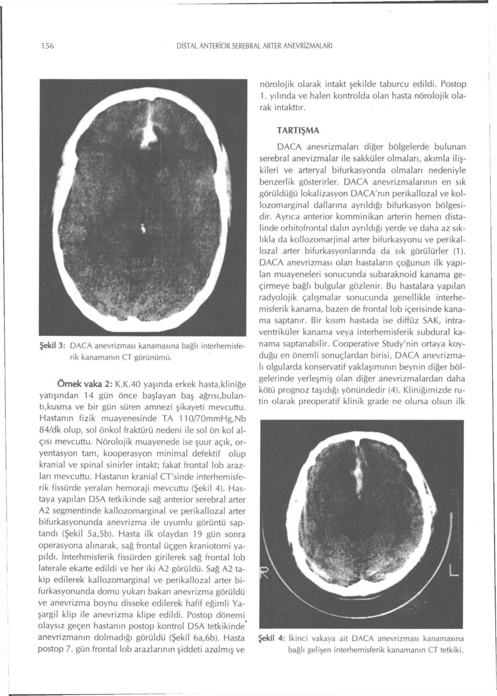 156 DİSTAL ANTERİOR SEREBRAL ARTER ANEVRİZMALARI nörolojik olarak intakt şekilde taburcu edildi. Postop 1. yılında ve halen kontrolda olan hasta nörolojik olarak intakttır.