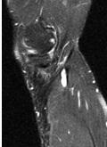 Resim 1 Resim 1: USG'de sol diz yukarısından başlayıp, kruris 1/3 proksimal kesim seviyesinde sonlanan, yaklaşık olarak 5.5x1 cm boyutlarında tubuler anekoik kistik natürde lezyon.
