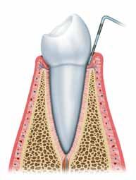 Periodontoloji Periodontoloji nedir? Periodontoloji, dişleri ve implantları çevreleyen yumuşak ve sert dokuların iltihabi hastalıkları ve bunların tedavisi ile ilgilenen bir dişhekimliği dalıdır.