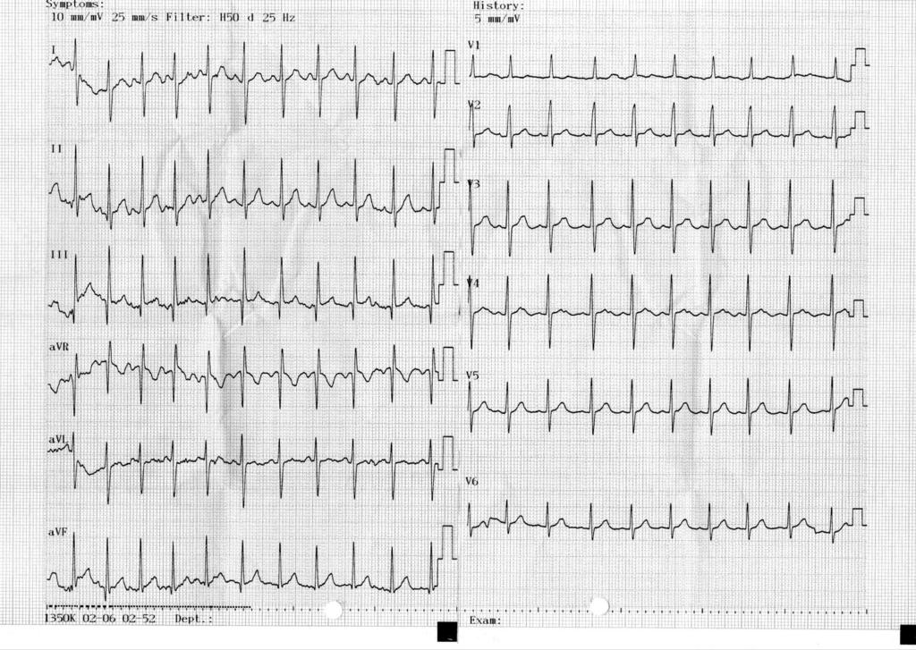 EKG