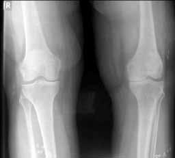 Çepni ve ark. Obez hastalarda unikompartmantal diz artroplastisi 123 (a) (b) (c) (d) Şekil 1. Cerrahi öncesi radyolojik değerlendirme.