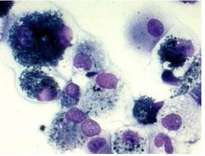 Resim-2. BAL örneği ( interstisyel akciğer hastalığı) (Roudebush VA Medical Center, Indiana University,USA) Akciğer Biyopsisi İPF nin histopatolojik tanısı UİP paternidir.