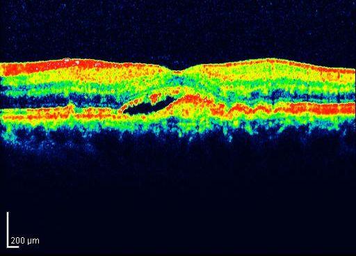 veya nörosensöryel retina altına doğru yayılım gösterir. RPE nin elevasyonuna neden olabilen fibrotik proliferasyon ile birliktedir (23).