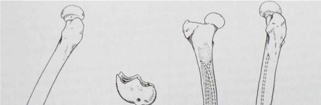 Başka bir yöntemde Rush pinleri femurun distalinde lateral ve medial kondillerin hafif proksimalinden ve