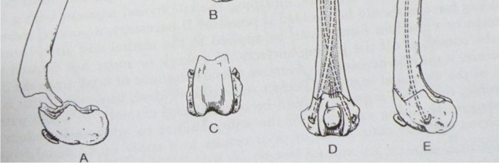 delikten meduller kanala yönlendirilir. Pinler femur un ¾ lük kısmına kadar gönderilmelidir.