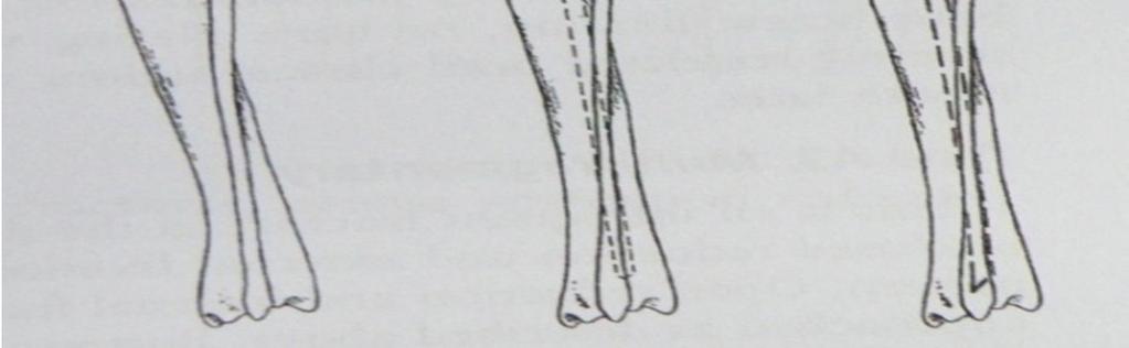 Tibia da Steinmann pininin Anterograd uygulaması (Denny ve Butterworth, 2000). Başka bir yöntemde osteosentez için Rush pini kullanılır.