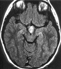 hamartomdan elde edilen MRS spektrumunda NAA de belirgin azalma izlenmektedir. ha ileri dönemde ilaç tedavisine dirençli jeneralize epileptik nöbetler izlenmiştir.