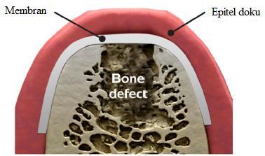 Geleneksel tedavi yöntemleri uygulamalarından sonra periodontal rejenerasyonu engelleyen temel nedenin; hasarlı bölgeye, epitel hücrelerin mezenkimal hücrelerden daha hızlı bir şekilde göç etmesi