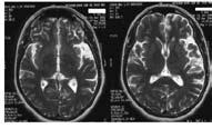 Babacan-Yıldız G 32 Nörogörüntüleme PPA lı hastaların çoğunda dominant hemisferin (sıklıkla sol) perisilvian bölgesinde genellikle komşu frontal, insular, temporal ve parietal bölgelere de yayılan