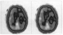 Hastalığın ilerleyen evrelerinde beynin diğer bölgelerinde de atrofiizlenir (8,15,18,20). Sağ hemisfer dominant hastalarda çok nadir olarak sağ persilviyan atrofi görülebilir (23).