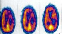 Gorno-Tempini ve arkadaşları ise 31 PPA lı hastayı inceledikleri çalışmalarında her üç tipin kendilerine spesifik fokal atrofilerinin olduğunu ve PNFA da asimetrik (sol>sağ) inferior frontal ve