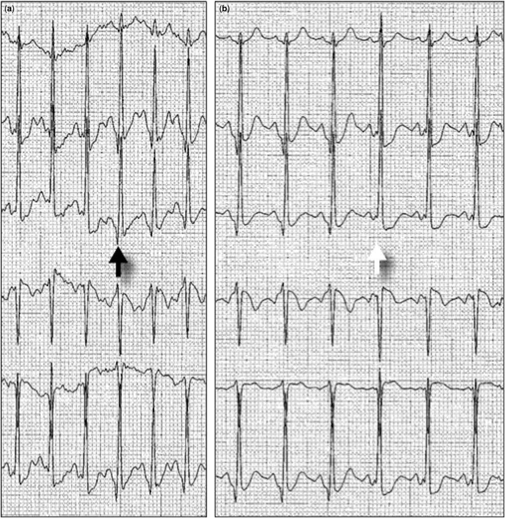 173 bpm,