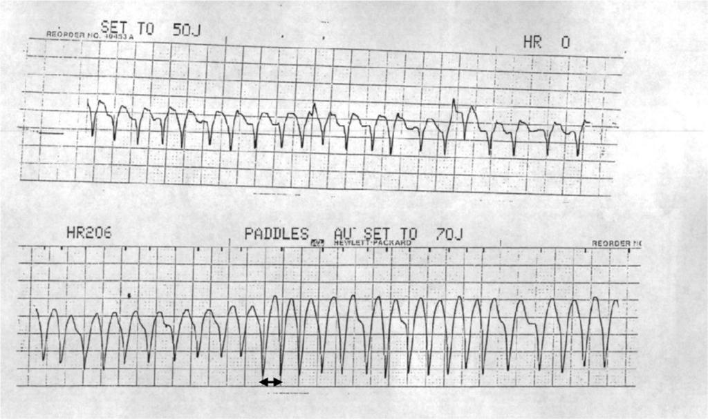 Non-invasive testler AF sırasında çekilebilmiş EKG varlığında; <220-250 ms, Shortest Pre-Excited R-R Interval (SPERRI) Intermittant WPW-düşük risk, yine de kardiak arrest