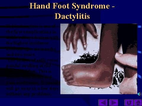 El-ayak Sendromu= Hand-foot syndrome=daktilit <3 yaş Diffuz, ağrılı el ve