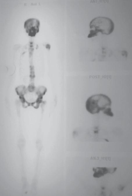 Çeneleri Etkileyen Sistemik Hastalık Bulguları ve Radyolojik Yorumları 789 B A C Resim 9. Paget hastasına ait A. Tam vücut sintigrafisi B. Panoramik radyografisi C.
