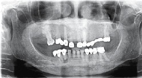 Maksillada kesici dişlerin arasında sonradan ortaya çıkan diastema dikkat çekicidir. Maksilladaki protüzyon ise ileri derecededir.