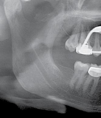 792 Diş Hekimliğinde radyolojinin esasları Hiperkortizolizm (Cushing sendromu) ister böbrek üstü bezlerinin disfonksiyonundan, isterse ekzojen kortikosteroid kullanımına bağlı olarak ortaya