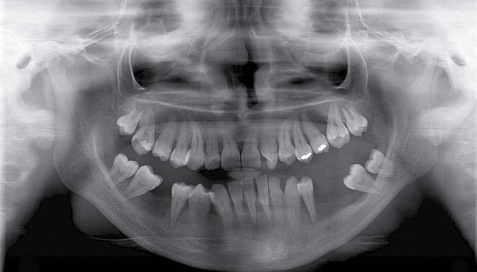 780 Diş Hekimliğinde radyolojinin esasları KAN HASTALIKLARINDA DENTAL RADYOLOJİK DEĞİŞİMLER Akut Lösemiler Hematolojik maliniteler, genellikle üç başlık altında toplanırlar.