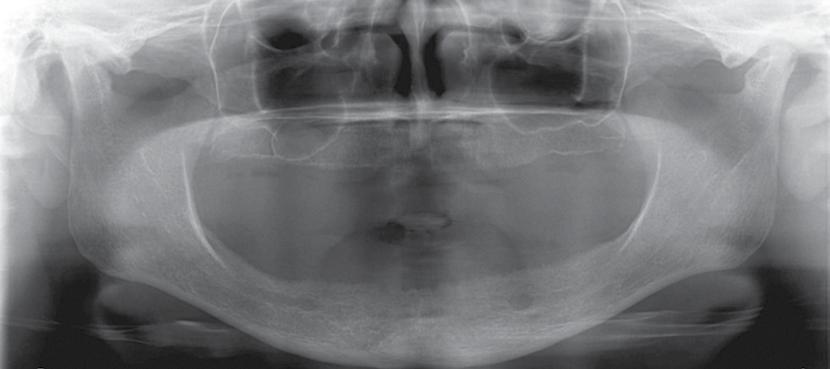 782 Diş Hekimliğinde radyolojinin esasları Talasemi (Cooley Anemisi, Akdeniz Anemisi, Eritroblastik Anemi) Talasemi, globulin genlerindeki kırılma sonucu hemoglobin sentezinde kalıcı bozukluğa yol