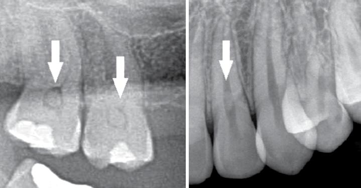 ve pulpa taşları izlenebilir (Resim 6,7). Periodontal ligament genişlemesi ve dişlerin mobilitesi sonucu dişler perküsyonda ve çiğneme sırasında ağrılıdır.