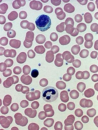 Sickle Cell Anaemia Sickle cell