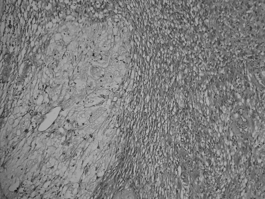 Akral miksoinflamatuar fibroblastik sarkom: Alt olgu sunumu rasyon indeksi %2 bulunmufltur. Eksizyon materyalinin cerrahi s n rlar nda tümör yoktur. OLGU6 eksizyon materyali ile de erlendirilmifltir.