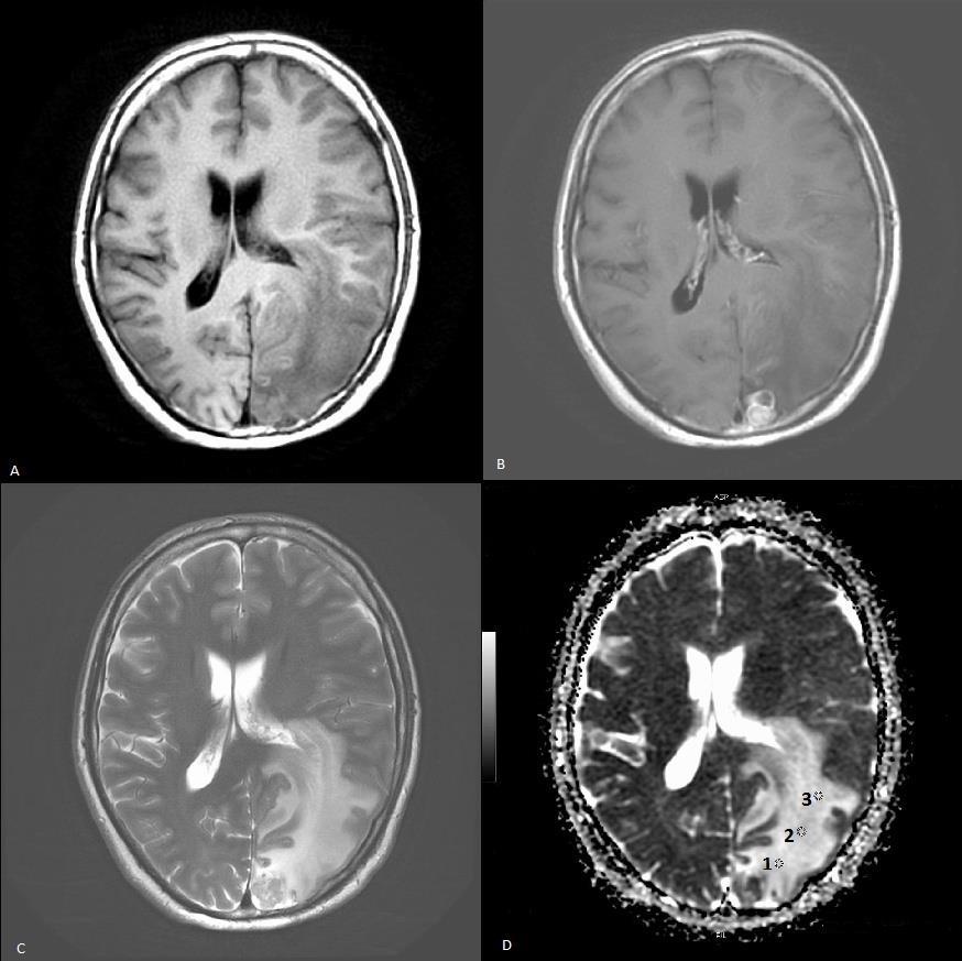 27 4.3. Olgu Örnekleri Olgu 1: 52 yaşında erkek, kolon CA soliter beyin metastazı tanılı hasta; a. T1 AG, b. Kontrastlı T1 AG, c. T2 AG, d.