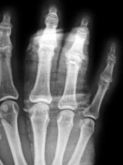 Parmak yumuşak doku yaralanmaları 217 Şekil 4. Aynı hastanın kemik çapası kullanılarak yapılan bağ rekonstrüksiyonu. sık görülür.