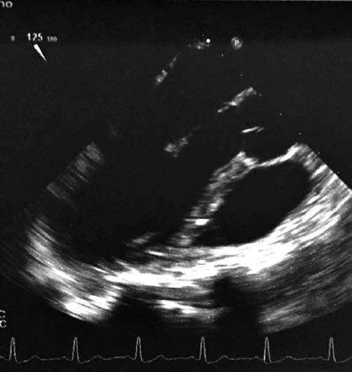 Ds DNA ve lupus antikoagülan testleri pozitif saptand. di er laboratuvar testleri do ald. Ekokardiografik incelemede; mitral kapakta 6 5 mm nodül ve mitral yetersizlik saptand.