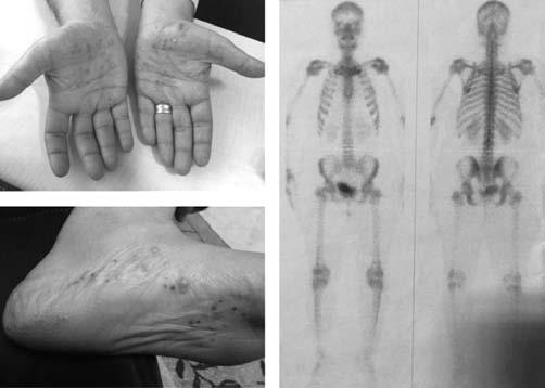 Anahtar sözcükler: Psoriyatik artrit, spondilit, yüksek akut faz PS-232 Ankilozan spondilitli bir hastada saptanan Cauda Equina Sendromu ve Anti-TNF tedavisinin etkinli i: Olgu sunumu Göksel Tan gör,