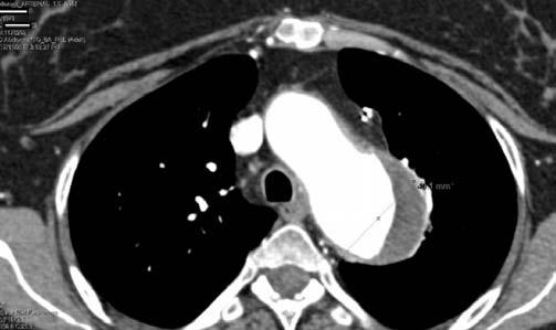 olmayan hastada masif pulmoner emboli geliflti. Takiplerinde ALT de eri 2 kat yükselen hastan n lamuvidin tedavisi sonland - r ld ve entekavir 0.5 mg/gün baflland.