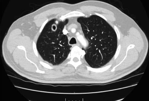 Bulgular: Plazmaferez uygulanan hastalar n 0 unda ANCA iliflkili vaskülit (AAV), 9 unda SLE, 2 sinde kriyoglobulinemik vaskülit (KV), inde de Good-Pasture sendromu tan s mevcuttu (Tablo PS-067).