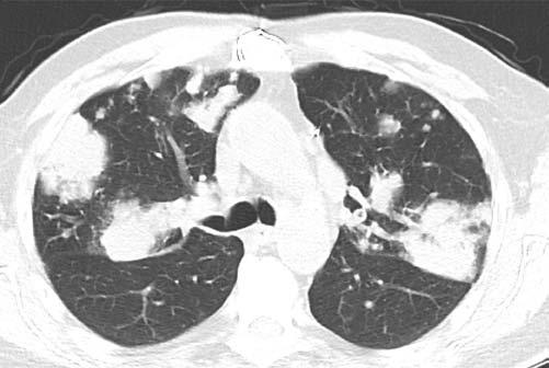 trakranial arterler duraya penetre olunca bu yap lar kaybettikleri için dev hücreli arterit kranial arterleri nadiren tutar.