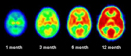 Erken çocukluk döneminde beyin gelişimi 1 aylık 3 aylık 6 aylık 12 aylık Sabbatini, R. M. (1997).