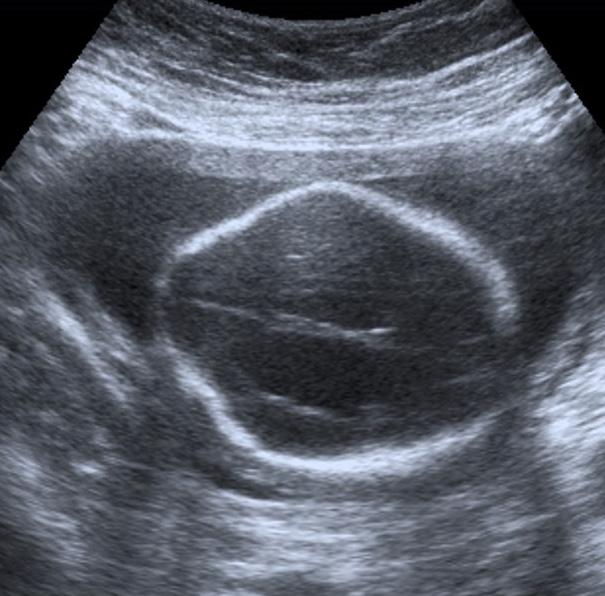 İkinci Trimester Ultrasonografi İncelemesi 205 anevrizmaları nadirdir ancak bu fetüslerin bir kısmında kromozom anomalisi ve ölüm görülür [4].
