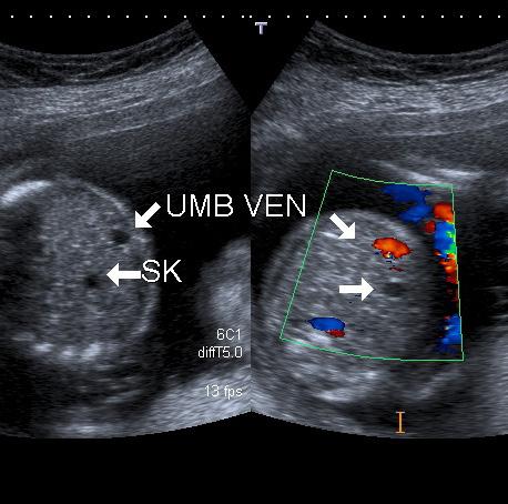 İkinci Trimester Ultrasonografi İncelemesi 209 armutumsu yapıda görülebilir (Resim 10). Yokluğu, bilier atrezi ya da kistik fibrozis ile ilişkili olabilir.