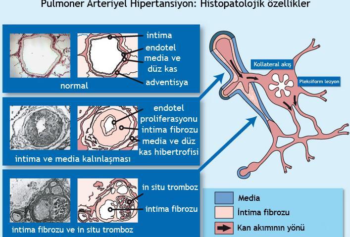 Patoloji Küçük arterlerde ; medial hipertrofi, intimal fibrozis Orta arterlerde; intimal proliferasyon,