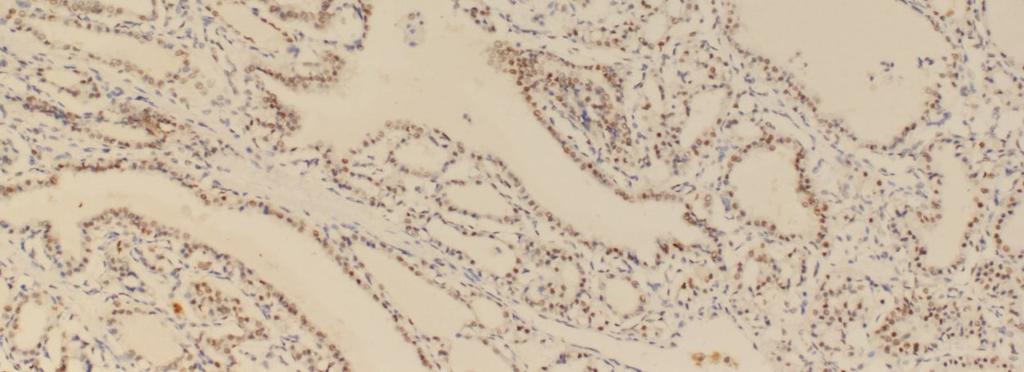 Kolloidal Guatrlı Olguların MSH2 Foliküler Hücre