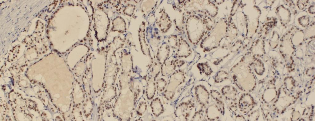 Resim 21 : Tiroid papiller karsinomun MLH1 ile immun boyanması, %50-100 foliküler hücre