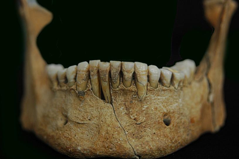 Cilt 11 Sayı 17, 2017, 24-37 Antik Toplumlarda Görülen Diş ve Çene Patolojilerinin Antropolojideki Önemi Resim 2.
