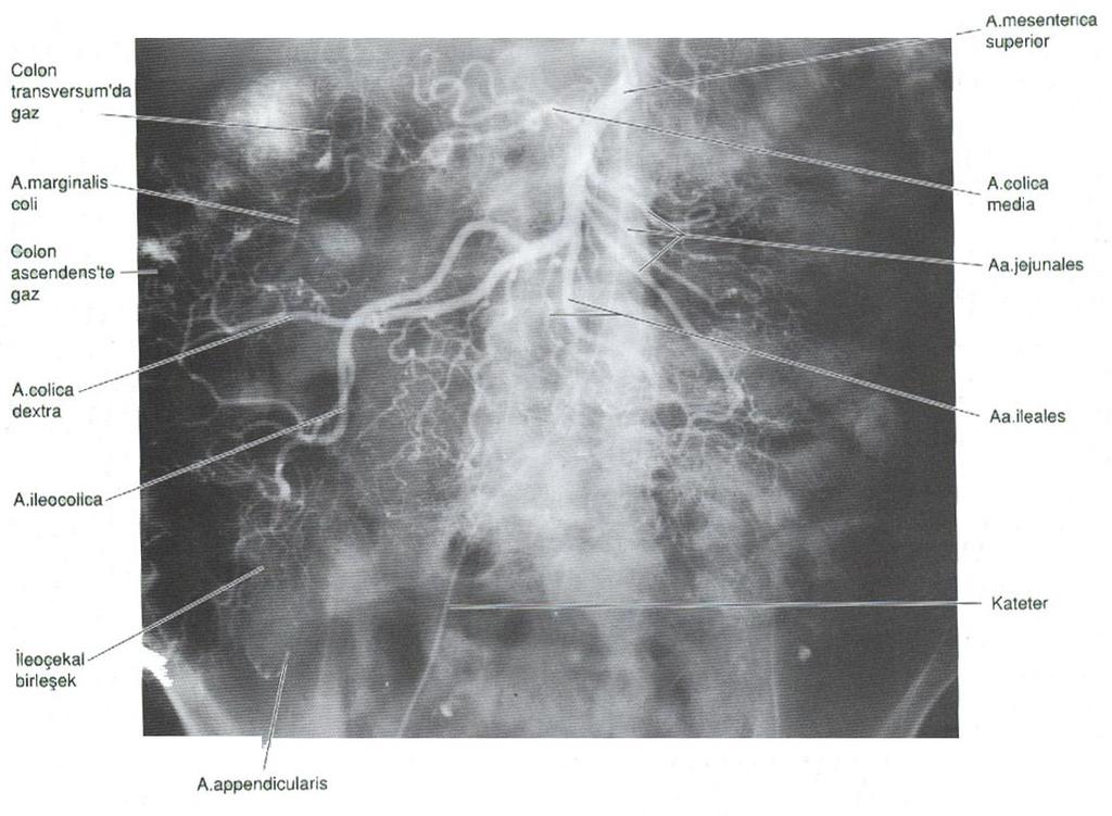 Şekil 1.16. A. femoralis e kateter aracılığı ile radyoopak madde enjekte edilerek elde edilen AMS nin arteriografik görüntüsü (Moore 2007).