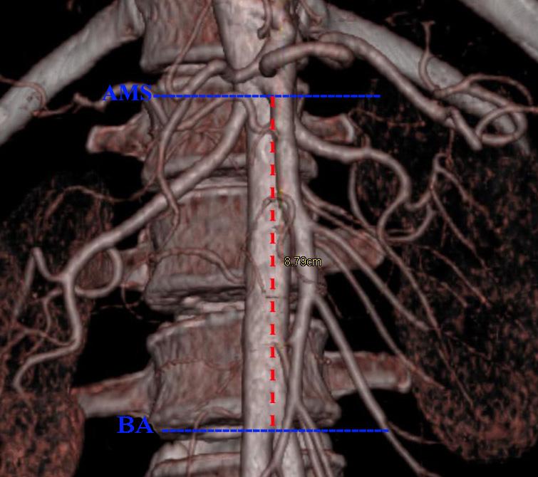 2.4. Arteria Mesenterica Superior İle İlgili Ölçümler - AMS nin AA dan orijin aldığı vertebra seviyesinin reformat sagittal, reformat koronal ve inspace görüntülerde tayini.