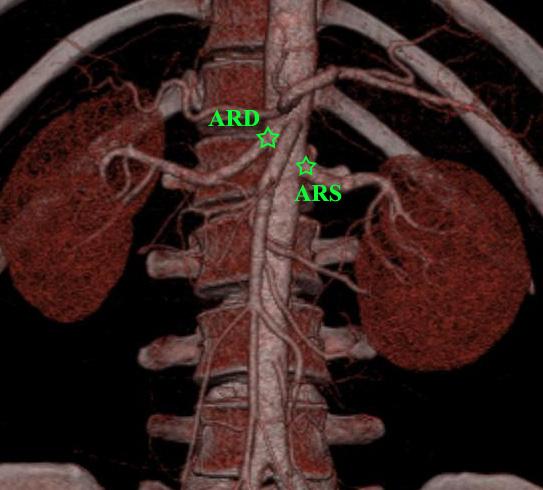 2.5. Arteria Renalis Dextra ve Sinistra İle İlgili Ölçümler - ARD ve ARS nin birbirlerine göre