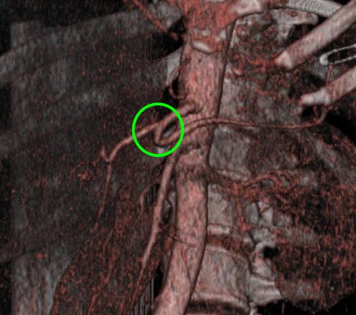 Truncus hepatosplenicus)(55 yaşında, kadın). Şekil 3.20.