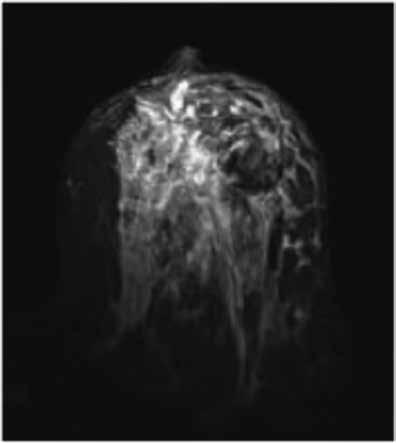 Ultrasonografi de sol memede santralde daha belirgin dilate duktuslar ve duktus lümenlerinden yer yer taşan bazıları sferik