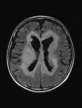 beyin MR görüntüleri çok çözünürlüklü dalgacık paketi dönüşümü ve SOM ağları kullanılarak kendilerini oluşturan gri madde, beyaz madde ve beyin sıvısı dokularına bölütlenmiştir.