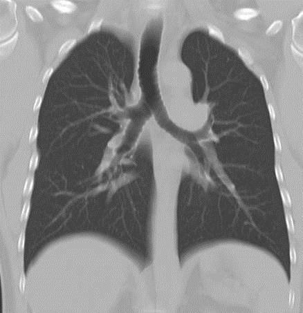 Sol üst lob bronşu sol pulmoner arter