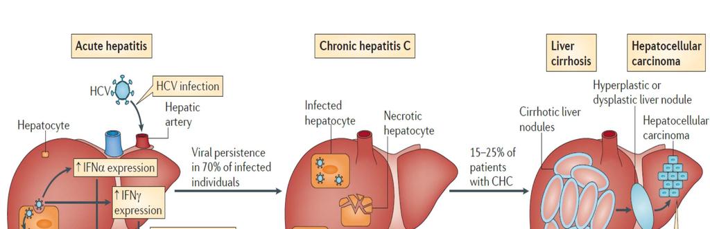 Hepatit C: Doğal Seyri Akut hepatit Kronik hepatit Siroz HCC Hepatosit HCV infek.