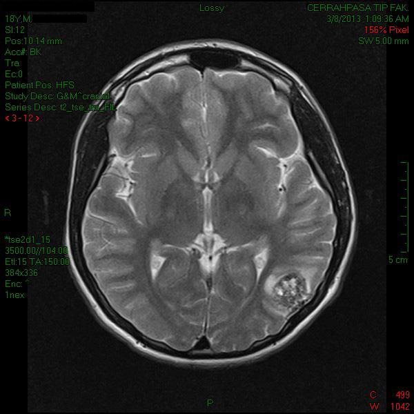 Meningioangiomatosis perivasküler hücreler EMA (Thermo, GP1-4, 1/500 dilusyon) ile yer yer membranöz pozitif boyandı.