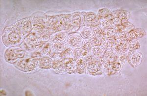 Fatty Yağlı Silendir Yağlı silendirler lipitten zengin epitel hücrelerin dejenerasyonu ile oluşurlar. Silendirin protein yapısı içerisinde yağ vakuolleri dikati çeker.